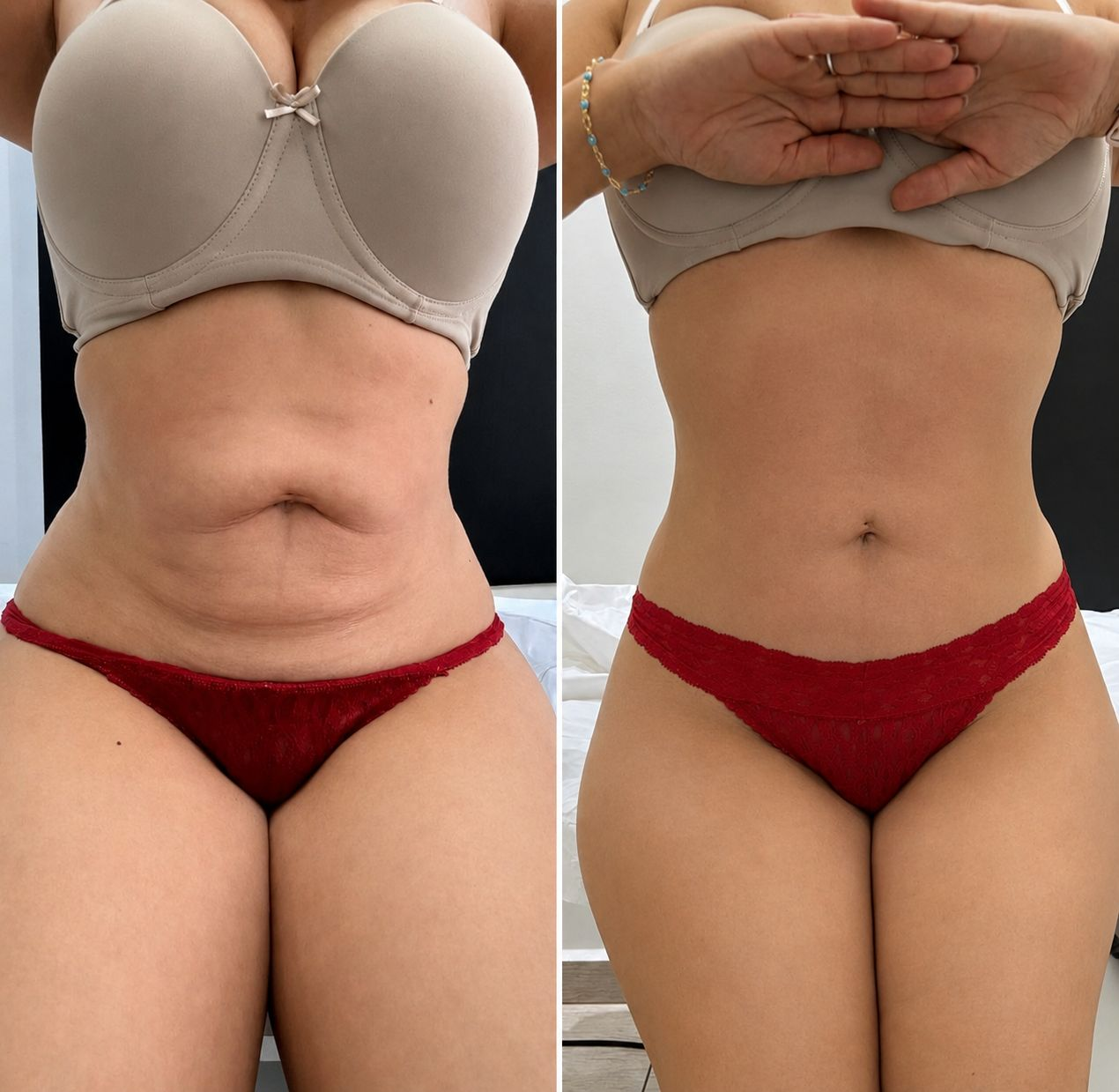 Before and after tummy transformation 1
