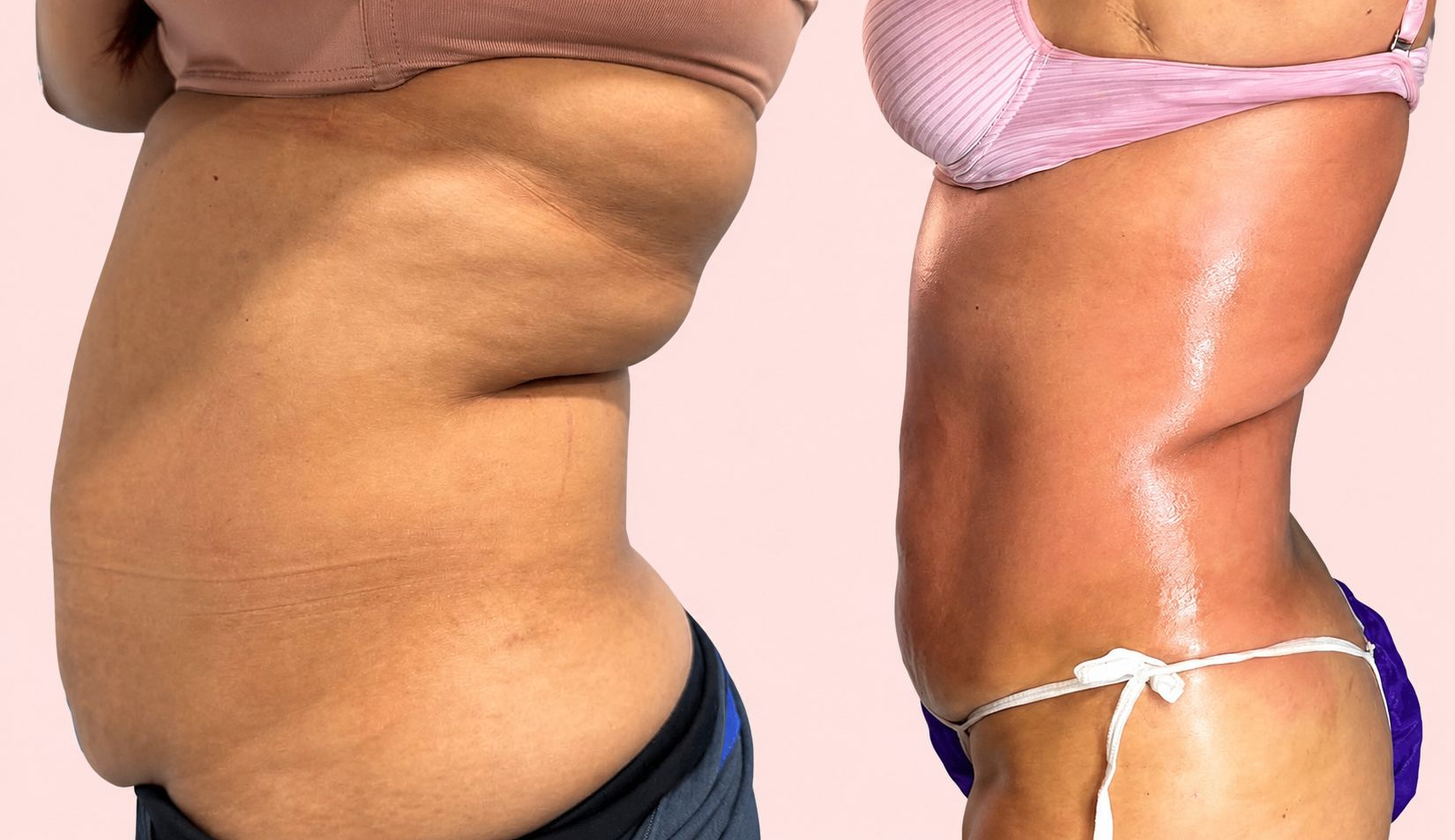 Before and after tummy transformation 5