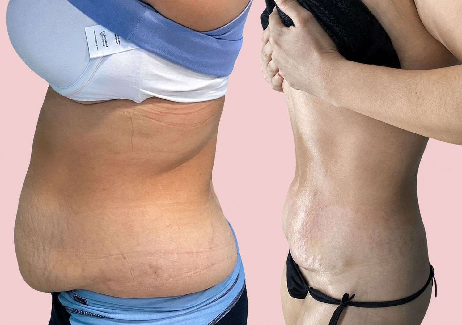 Before and after tummy transformation 4