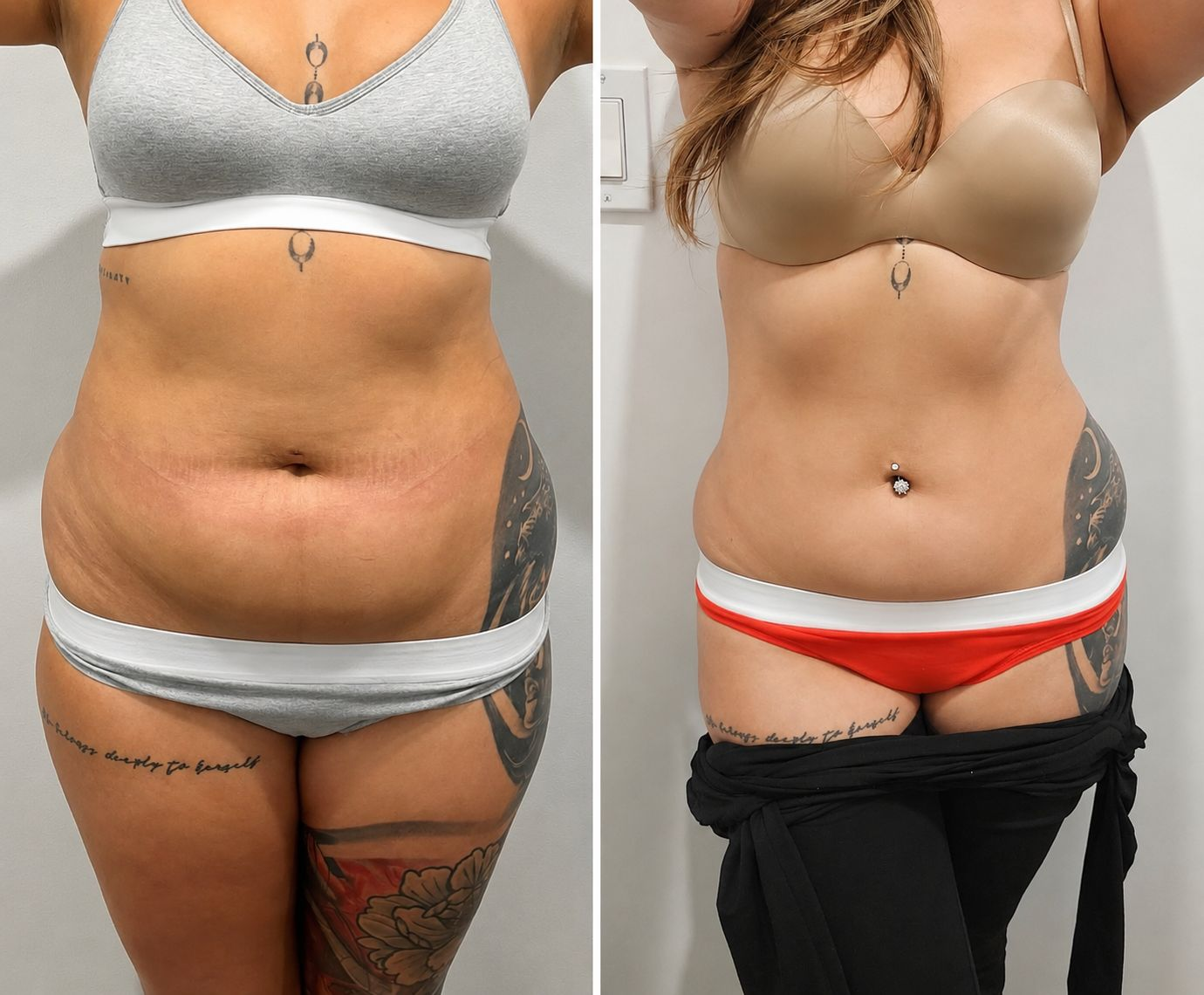 Before and after tummy transformation 6