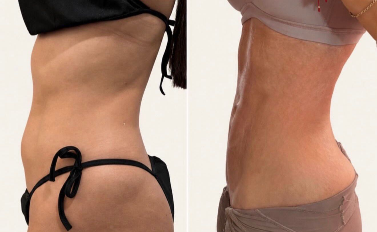 Before and after tummy transformation 2