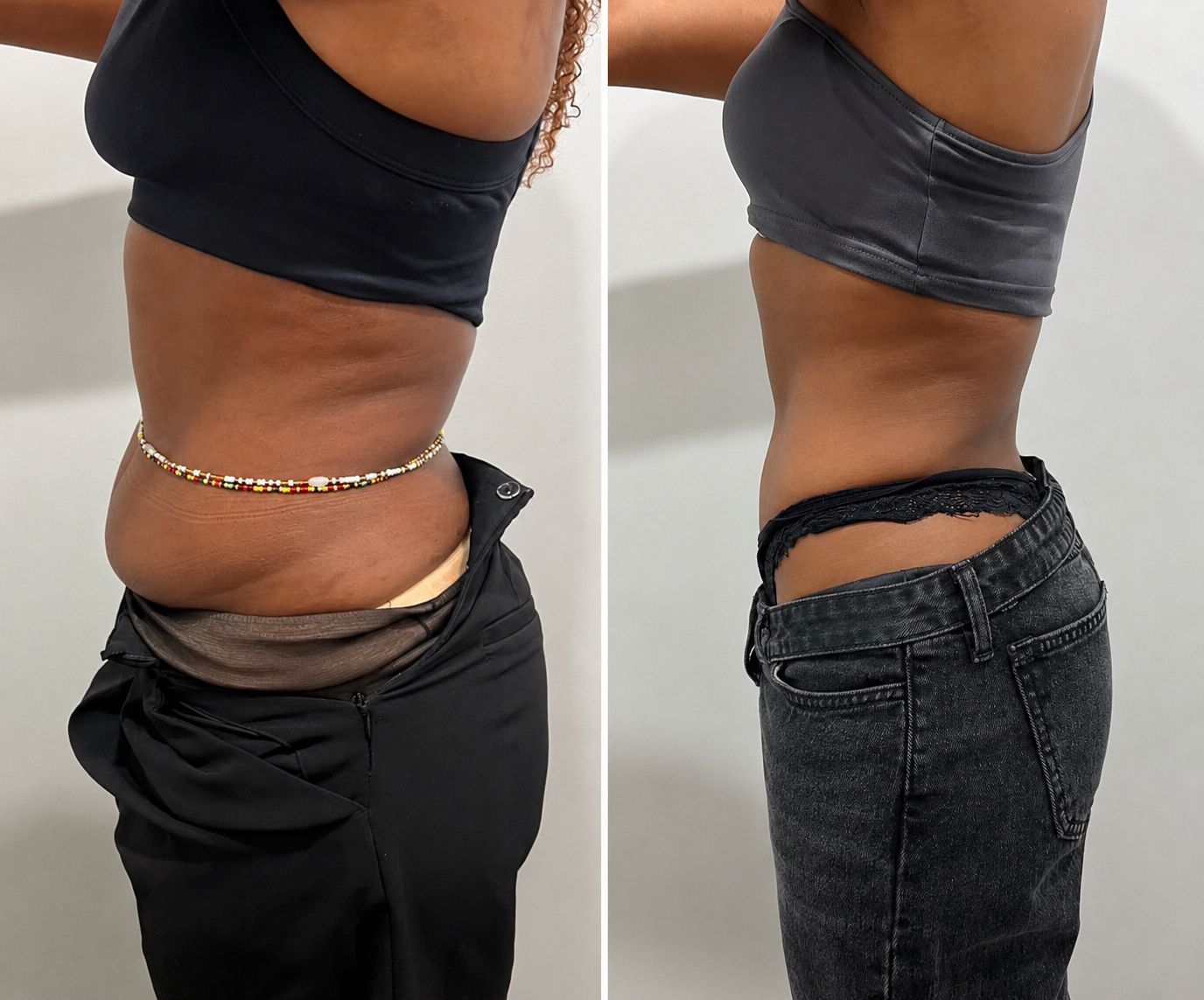 Before and after tummy transformation 3